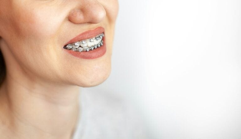 5 Great Reasons to Get Your Teeth Straightened The smile of a young girl with braces on her white teeth. Teeth straightening.