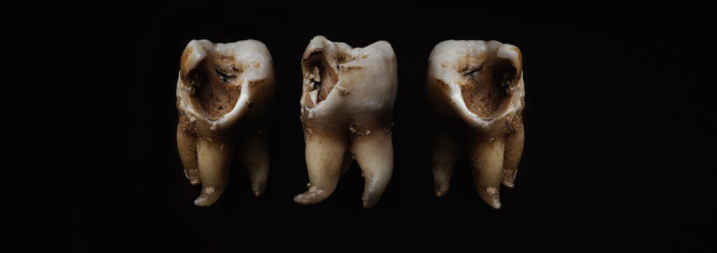 The Oral-Systemic Link: Risk Factors for Tooth Decay tooth decay