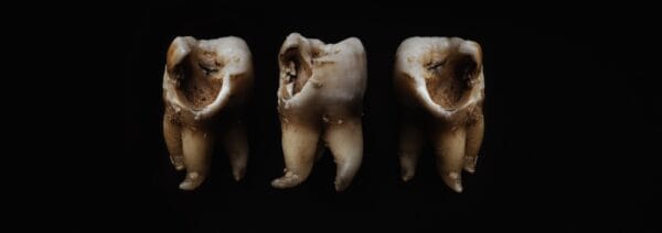 treating tooth decay